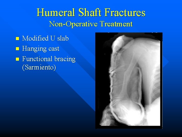 Humeral Shaft Fractures Non-Operative Treatment n n n Modified U slab Hanging cast Functional