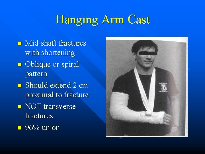 Hanging Arm Cast n n n Mid-shaft fractures with shortening Oblique or spiral pattern