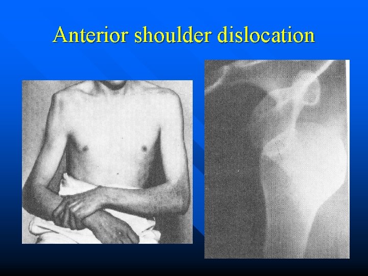 Anterior shoulder dislocation 