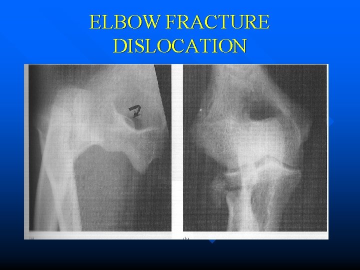 ELBOW FRACTURE DISLOCATION 