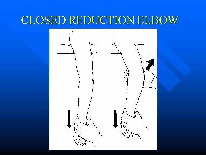 CLOSED REDUCTION ELBOW 