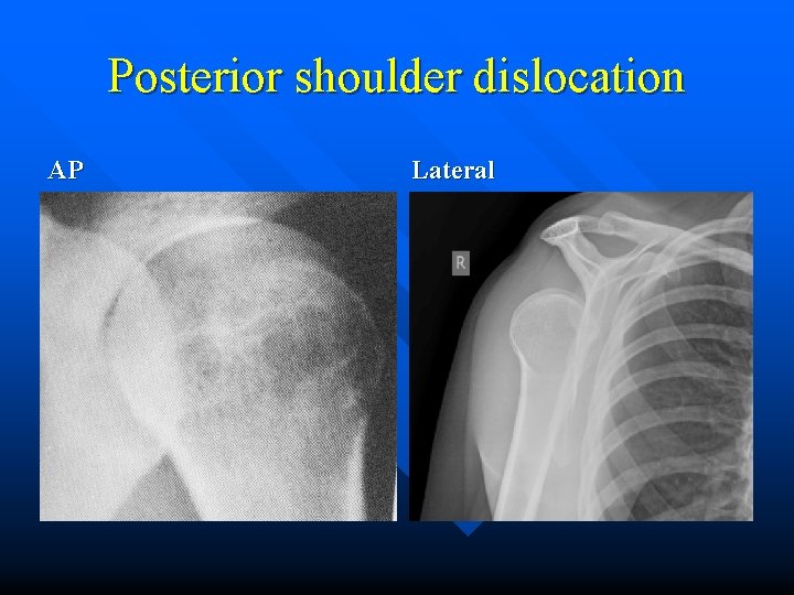 Posterior shoulder dislocation AP Lateral 