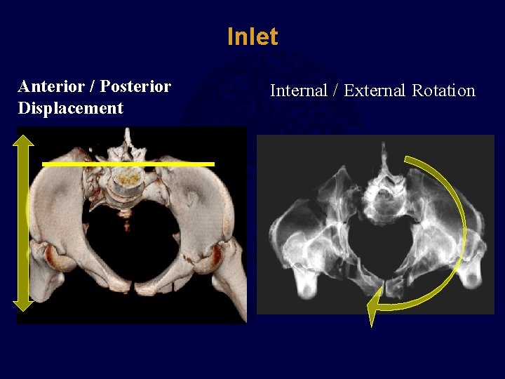 Inlet Anterior / Posterior Displacement Internal / External Rotation 