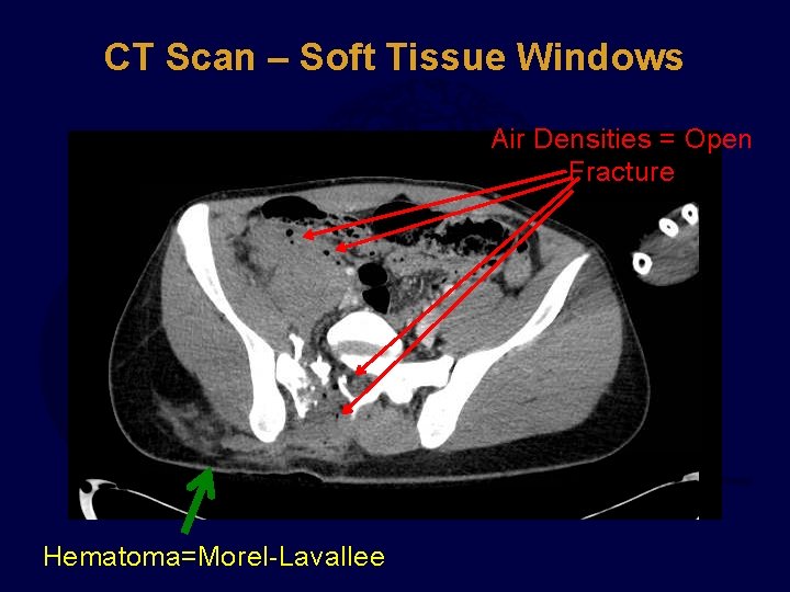 CT Scan – Soft Tissue Windows Air Densities = Open Fracture Hematoma=Morel-Lavallee 