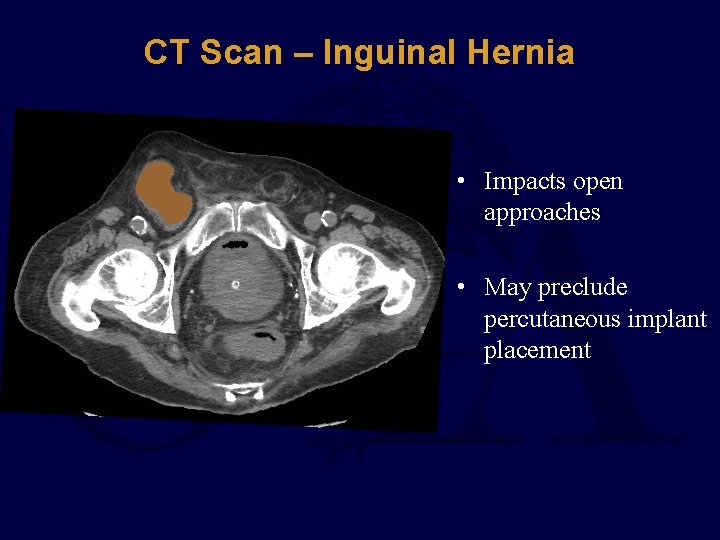 CT Scan – Inguinal Hernia • Impacts open approaches • May preclude percutaneous implant