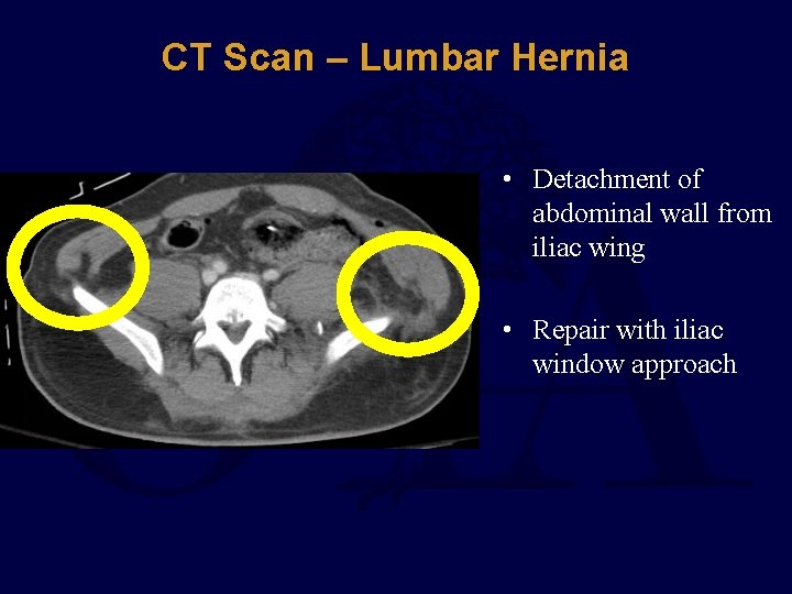 CT Scan – Lumbar Hernia • Detachment of abdominal wall from iliac wing •