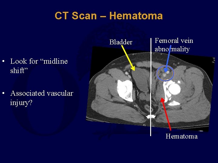 CT Scan – Hematoma Bladder Femoral vein abnormality • Look for “midline shift” •