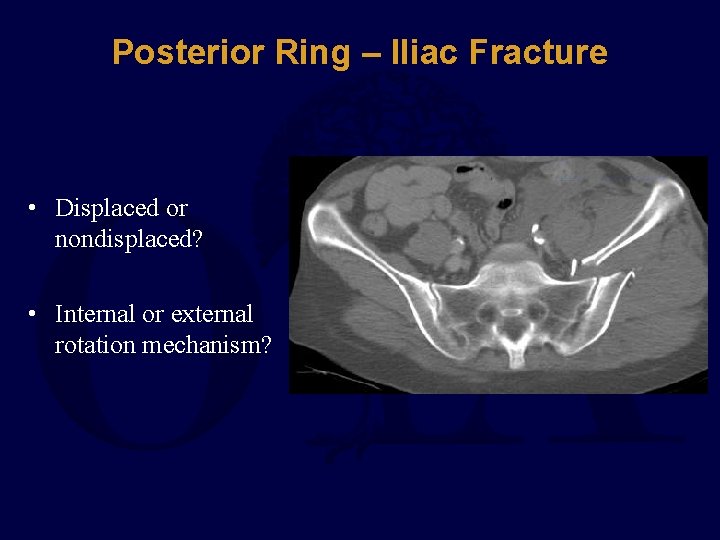Posterior Ring – Iliac Fracture • Displaced or nondisplaced? • Internal or external rotation
