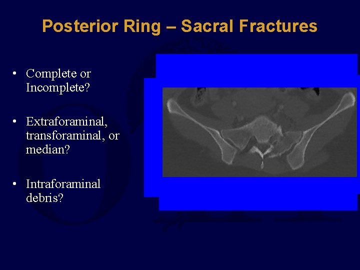 Posterior Ring – Sacral Fractures • Complete or Incomplete? • Extraforaminal, transforaminal, or median?