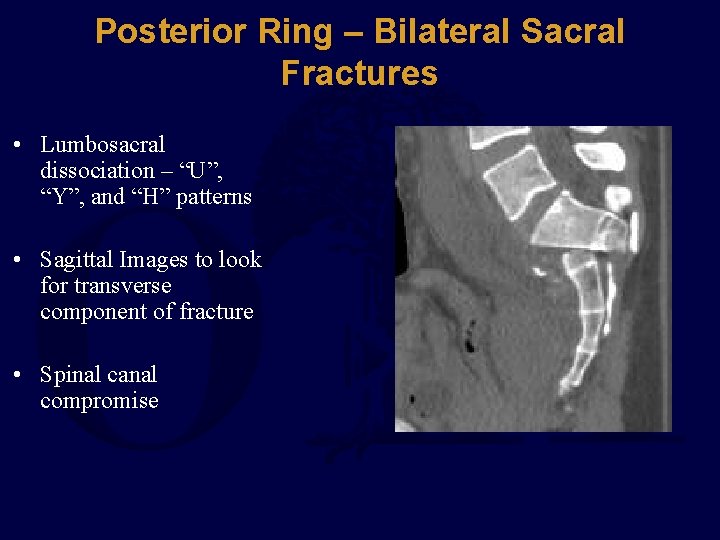 Posterior Ring – Bilateral Sacral Fractures • Lumbosacral dissociation – “U”, “Y”, and “H”