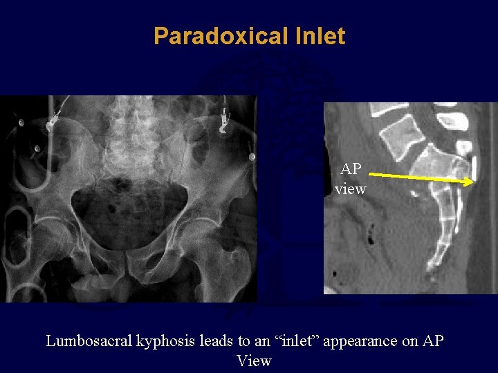 Paradoxical Inlet AP view Lumbosacral kyphosis leads to an “inlet” appearance on AP View