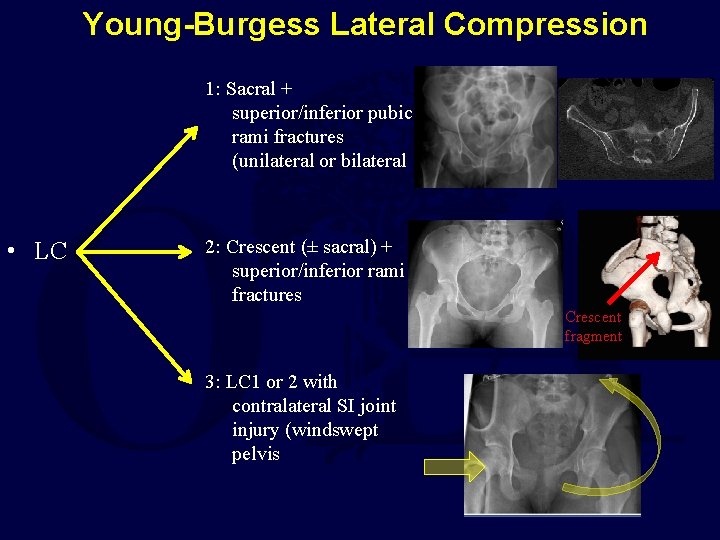 Young-Burgess Lateral Compression 1: Sacral + superior/inferior pubic rami fractures (unilateral or bilateral •