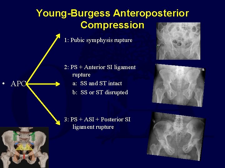 Young-Burgess Anteroposterior Compression 1: Pubic symphysis rupture • APC 2: PS + Anterior SI