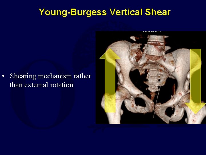 Young-Burgess Vertical Shear • Shearing mechanism rather than external rotation 