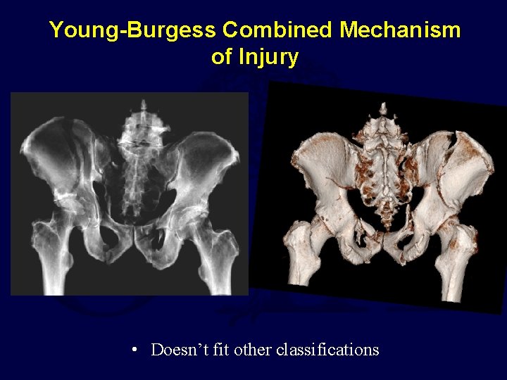Young-Burgess Combined Mechanism of Injury • Doesn’t fit other classifications 