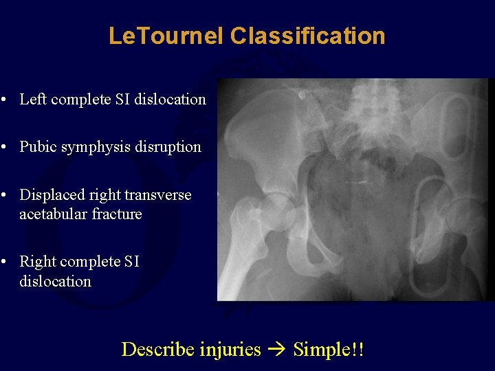 Le. Tournel Classification • Left complete SI dislocation • Pubic symphysis disruption • Displaced
