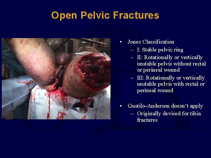 Open Pelvic Fractures • Jones Classification – I: Stable pelvic ring – II: Rotationally