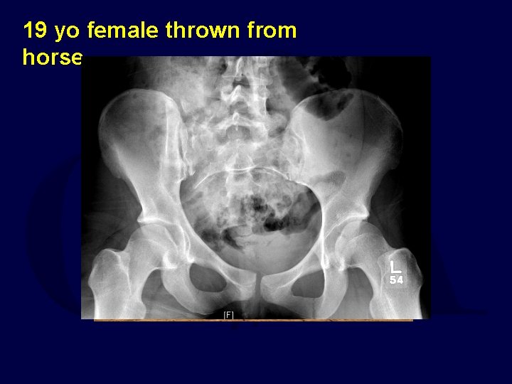 19 yo female thrown from horse 