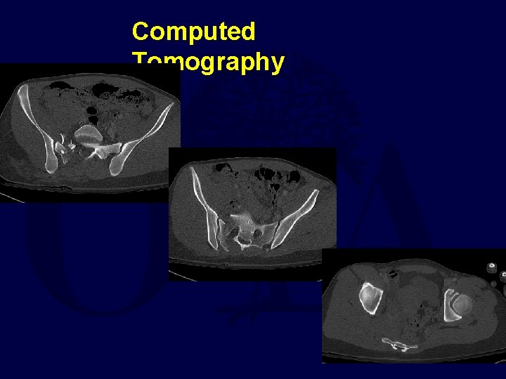 Computed Tomography 