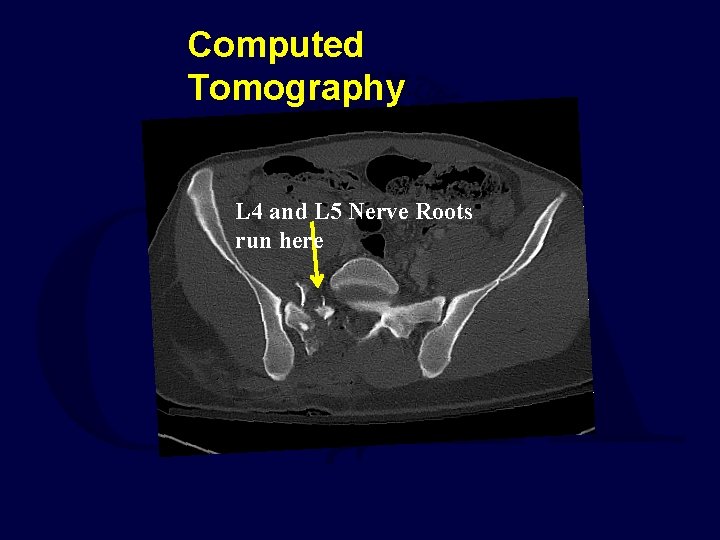 Computed Tomography L 4 and L 5 Nerve Roots run here 