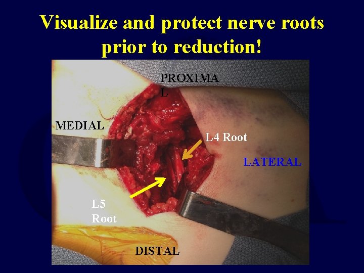 Visualize and protect nerve roots prior to reduction! PROXIMA L MEDIAL L 4 Root