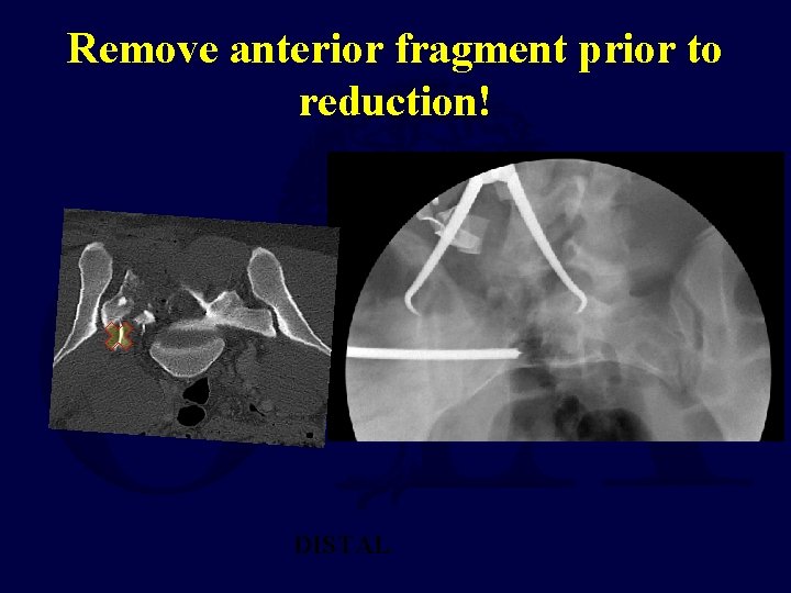 Remove anterior fragment prior to reduction! DISTAL 