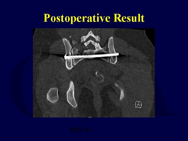 Postoperative Result DISTAL 