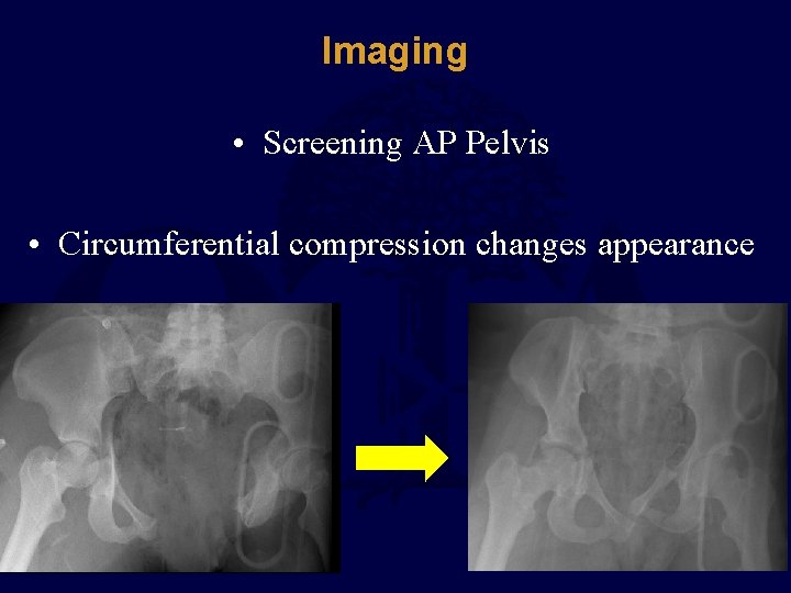 Imaging • Screening AP Pelvis • Circumferential compression changes appearance 