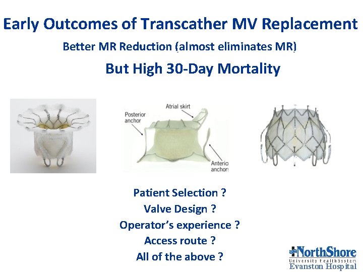 Early Outcomes of Transcather MV Replacement Better MR Reduction (almost eliminates MR) But High Early Outcomes of Transcather MV Replacement Better MR Reduction (almost eliminates MR) But High