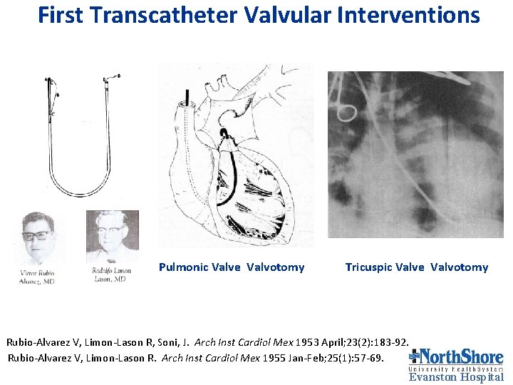 First Transcatheter Valvular Interventions Pulmonic Valve Valvotomy Tricuspic Valve Valvotomy Rubio-Alvarez V, Limon-Lason R, First Transcatheter Valvular Interventions Pulmonic Valve Valvotomy Tricuspic Valve Valvotomy Rubio-Alvarez V, Limon-Lason R,