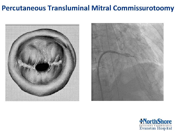 Percutaneous Transluminal Mitral Commissurotoomy Evanston Hospital Percutaneous Transluminal Mitral Commissurotoomy Evanston Hospital