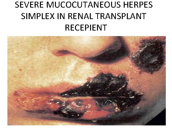 SEVERE MUCOCUTANEOUS HERPES SIMPLEX IN RENAL TRANSPLANT RECEPIENT 