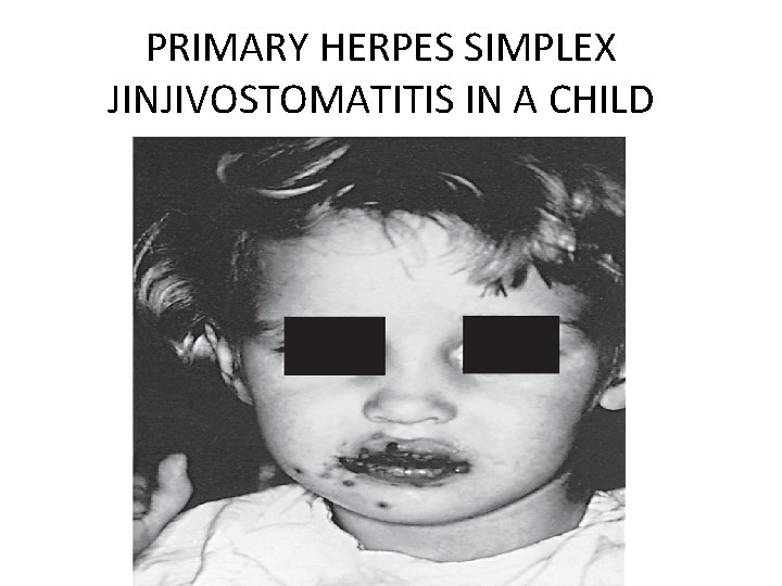 PRIMARY HERPES SIMPLEX JINJIVOSTOMATITIS IN A CHILD 