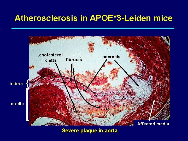 Atherosclerosis in APOE*3 -Leiden mice cholesterol fibrosis clefts intima necrosis { media Affected media