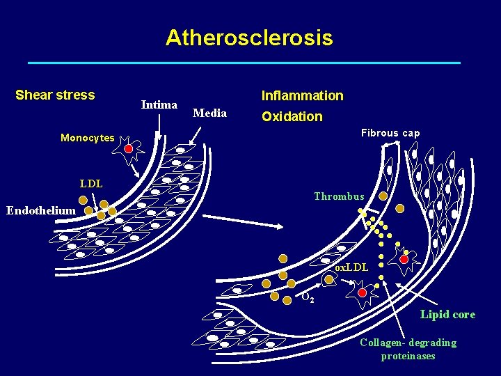 Atherosclerosis Shear stress Intima Inflammation Media Oxidation Fibrous cap Monocytes LDL Thrombus Endothelium ox.