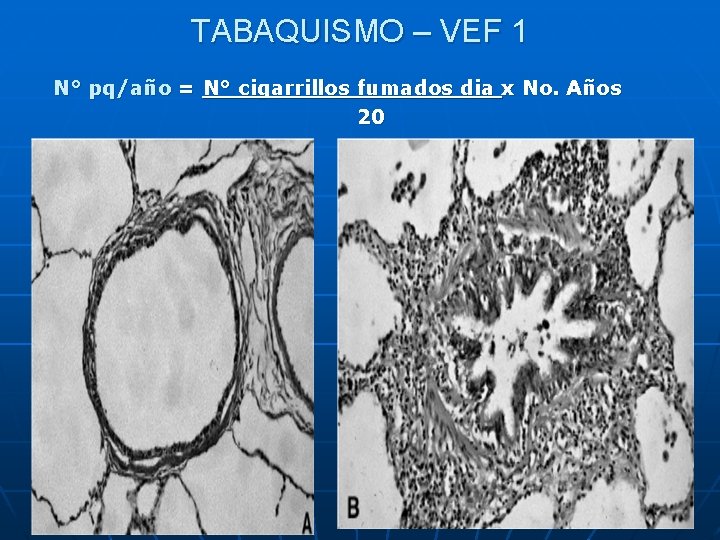 TABAQUISMO – VEF 1 N° pq/año = N° cigarrillos fumados dia x No. Años