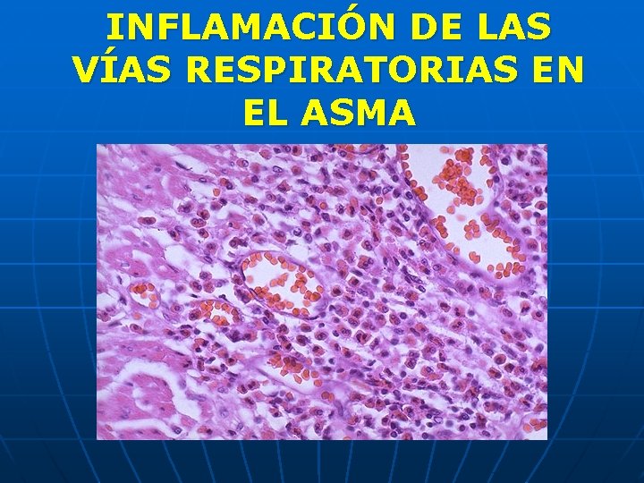 INFLAMACIÓN DE LAS VÍAS RESPIRATORIAS EN EL ASMA 