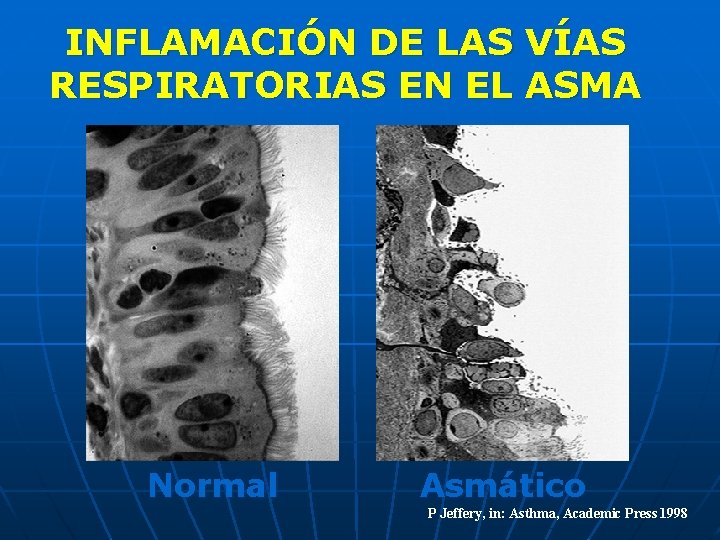 INFLAMACIÓN DE LAS VÍAS RESPIRATORIAS EN EL ASMA Normal Asmático P Jeffery, in: Asthma,