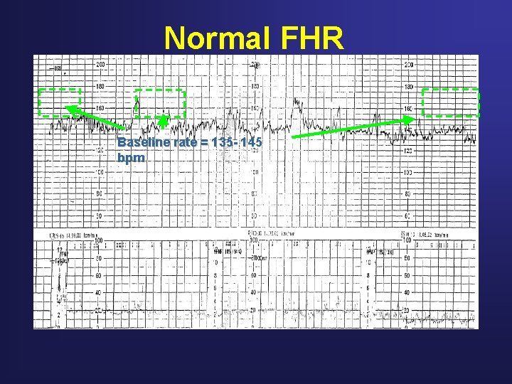 Normal FHR Baseline rate = 135 - 145 bpm 