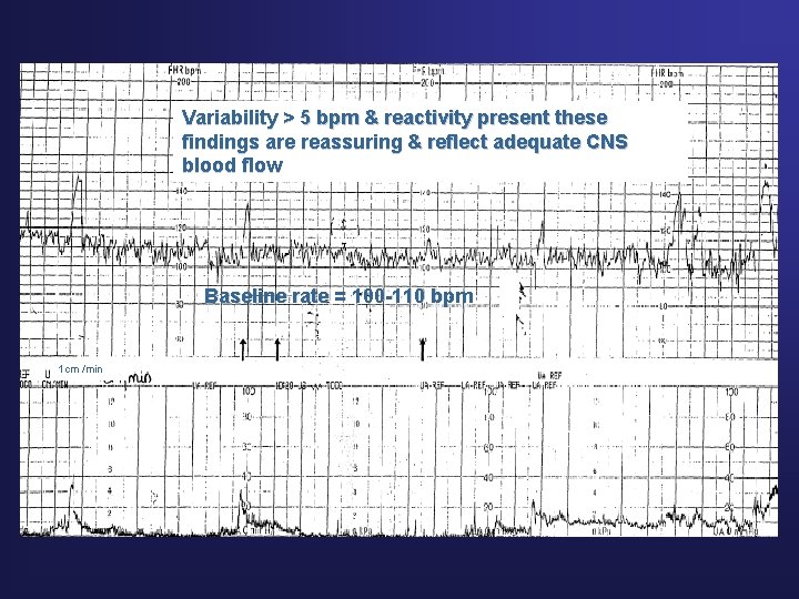 Baseline bradycardia Variability > 5 bpm & reactivity present these findings are reassuring &