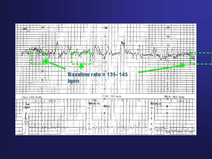 Normal FHR Baseline rate = 135 - 145 bpm 