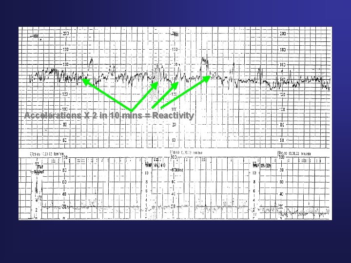 Accelerations X 2 in 10 mins = Reactivity 