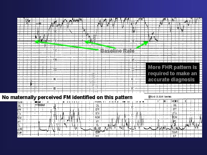 Baseline Tachycardia Baseline Rate More FHR pattern is required to make an accurate diagnosis