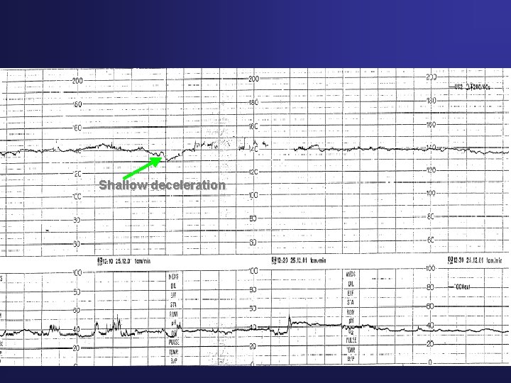 Shallow deceleration 