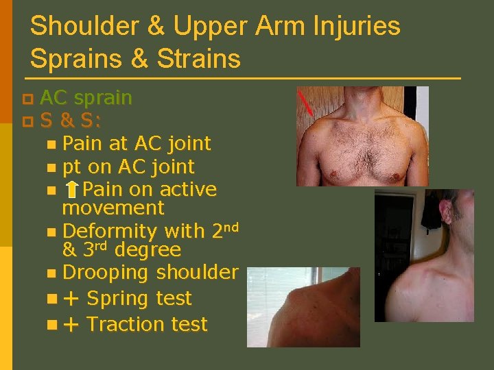 Shoulder & Upper Arm Injuries Sprains & Strains AC sprain p S & S: