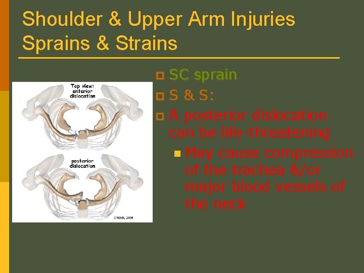 Shoulder & Upper Arm Injuries Sprains & Strains SC sprain p S & S: