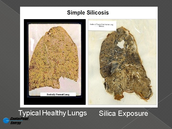 Typical Healthy Lungs Silica Exposure 