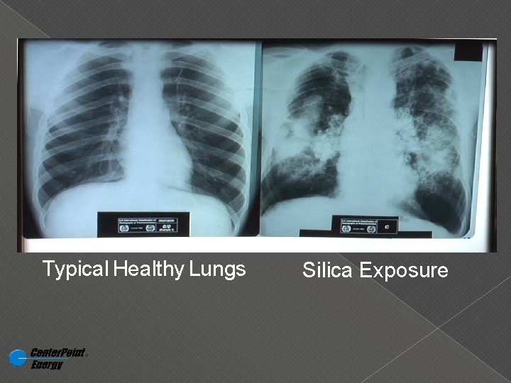 Typical Healthy Lungs Silica Exposure 