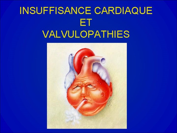 INSUFFISANCE CARDIAQUE ET VALVULOPATHIES 