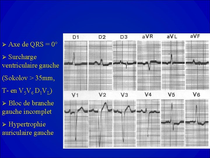 Ø Axe de QRS = 0° Surcharge ventriculaire gauche Ø (Sokolov > 35 mm,